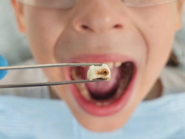 Best Knocked-Out Tooth Emergency  in Indianola, MS